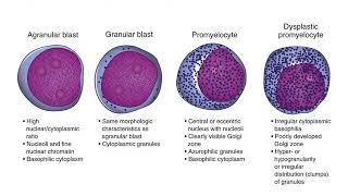 Myelodysplastic Syndrome [upl. by Sicnarf88]