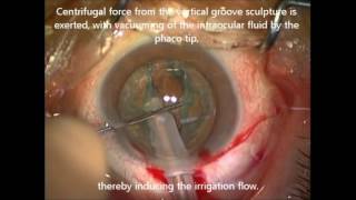 iH during phacoemulsification cataract surgery  ID 124528 [upl. by Kikelia]