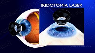 Glaucoma ad angolo chiuso e glaucoma acuto terapia con iridotomia laser wwwoculisticaTVit [upl. by Liartnod]