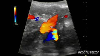 Obstetric Doppler ultrasound method of identifying the vessels [upl. by Bevis441]