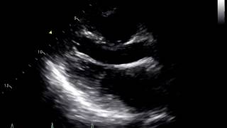 Constrictive Pericarditis Following Heart Transplant 1 [upl. by Fridlund]