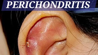 perichondritis earpain swelling treatment drbaisalisarkar ENTSurgeon kolkata [upl. by Winnifred]