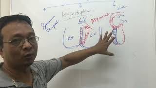 Cardiomyopathytypes and pathophysiology [upl. by Ailasor]