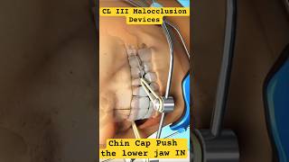 CL III Malocclusion Orthodontics Devices [upl. by Charpentier]