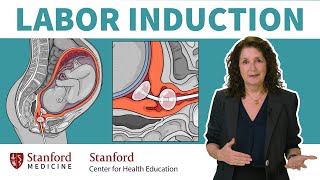 What is labor induction OBGYN answers 5 common questions about inducing labor  Stanford [upl. by Neslund]