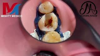 Using FURY L60 Rotary System in Obliterated amp Calcified Root Canals of Upper First Molar  RCT ENDO [upl. by Woodson]