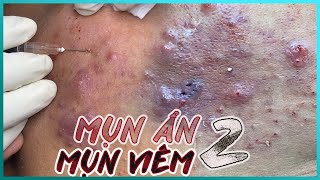 Big Cystic Acne Blackheads Extraction Blackheads amp Milia Whiteheads Removal Pimple Popping [upl. by Ahseuqal583]