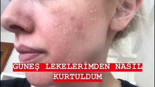 EYLÜL ÖZTÜRKGÜNEŞ LEKELERİMDEN NASIL KURTULDUMCİLTBAKIMI [upl. by Nnanerak]