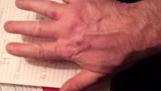 SKIN SPOTS BLOOD BLISTERS RASH SCABS ZOMBIE VIRUS AGENDA 21 [upl. by Dotty]