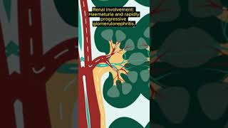 MRCP Exam tip CGPA vs EGPAGranulomatosis with polyangiitis [upl. by Orfield625]