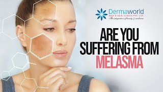 Suffering from Melasma Heres the solution [upl. by Teerpnam]