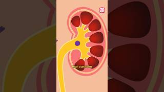 What Causes Kidney Stones  World Kidney Day Special shorts kidneystone worldkidneyday [upl. by Cavallaro]