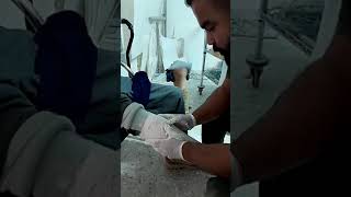 Toma de mole transtibial  Prótesis abajo de rodilla [upl. by Rede577]