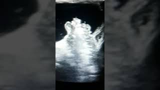 Ultrasound guided Hydrostatic Reduction of Intussusception [upl. by Harriott22]