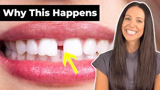 Why Do People Have GAP TEETH amp How To Fix It Diastema Explained [upl. by Salli]