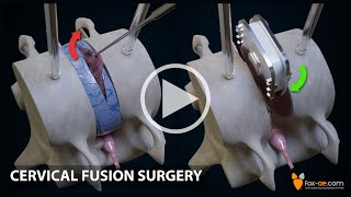 Anterior Cervical Fusion [upl. by Nylodnarb]