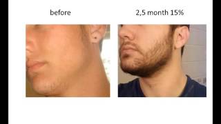 Stimulate Beard Growth with Minoxidil Before amp After [upl. by Robbert]