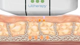 How the Ultherapy Treatment Works [upl. by Nylkoorb498]