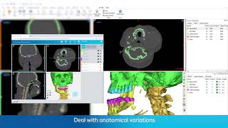 AIEnabled Automatic CMF Segmentation  Mimics Innovation Suite 24 [upl. by Woodcock]