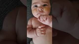 respiratory distress in a 3 month old baby Grunting retractions and seesaw breathing [upl. by Submuloc131]