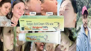 Aziderm 10 Cream  Honest Review [upl. by Angelique664]