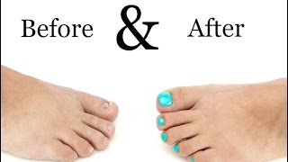 Toenail Treatment  Miracle Gelous Reconstruction [upl. by Brody173]