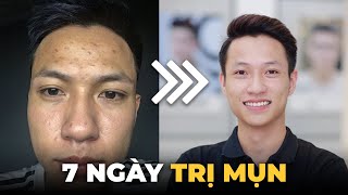 HƯỠNGDẪN  7 Ngày Trị Mụn Tận Gốc Đơn Giản Tại Nhà [upl. by Lussier]