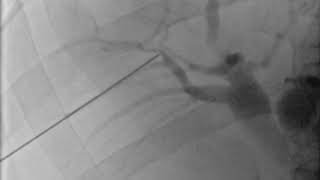 Percutaneous Biliary access under Fluoroscopy [upl. by Fredric]