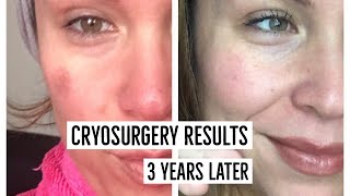 Cryosurgery Results 3 Years Update [upl. by Enomys]