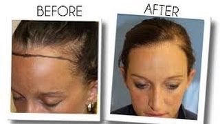 Womens Hair Loss Treatment  Minoxidil  Arganrain  Before and After 15 Results [upl. by Oilalue]