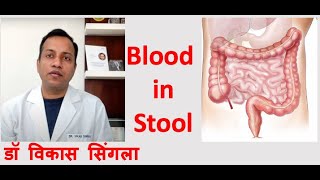 Reason for Blood in Stool  Causes and Treatment in Hindi [upl. by Cassie]