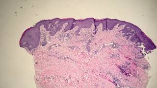 Acantholytic Dermatoses consistent with Hailey Hailey Disease [upl. by Huckaby]