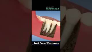 Root Canal Treatment  Dental experiencein [upl. by Fredericka]