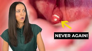 How to PREVENT Tonsil Stones [upl. by Ahseiat824]