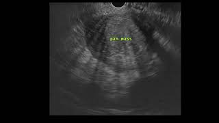 EUSGuided Fine Needle Biopsy of a Pancreatic Mass [upl. by Rivard]