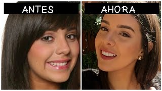 DISEÑO DE SONRISA  DIENTES GRANDES STORY TIME [upl. by Eniahpets]