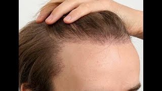 Microneedling amp Hair Loss  Does it work [upl. by Mikeb]