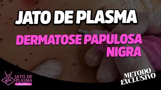 Aula Protocolo exclusivo para Dermatose Papulosa Nigra com Jato de Plasma 100 não invasiva [upl. by Ardnahc340]