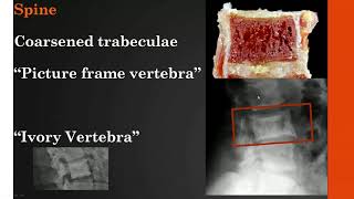 Imaging Paget disease of bone [upl. by Marena790]