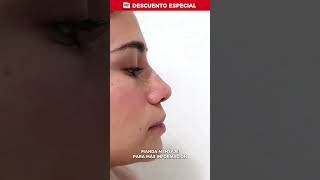 ANTES Y DESPUÉS RINOMODELACIÓN BuenFin2024 rinomodelacion rinoplastia belleza antesydespues [upl. by Ilbert]