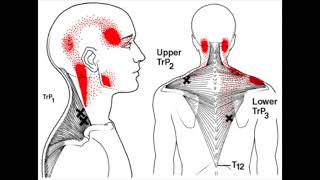 Safe Technique for Dry Needling Trapezius Trigger Point [upl. by Barn]