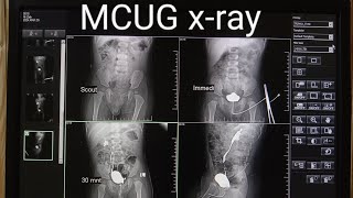 MCUGVCUG xRay procedure micturating cystourethrogram  MCUGVCUG test in Radiology [upl. by Oconnor]