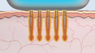 Animation Radiofréquence MicroNeedle Secret [upl. by Novello291]