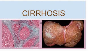 Cirrhosis [upl. by Mastrianni905]