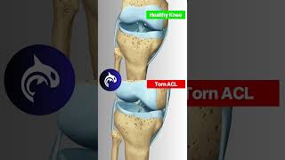 Why ACL Tears are such a nightmare for athletes acl [upl. by Benil]