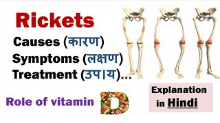 Rickets  Causes Symptoms Diagnosis Treatments  Rickets [upl. by Norean8]