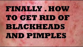 HOW TO GET RID OF BLACKHEADS AND PIMPLES Permanently [upl. by Acey]