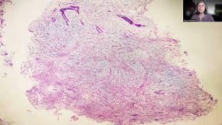 Tip63 Myometrial Myxoidosis [upl. by Eanyl]