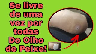 Olho de peixe no pé [upl. by Raskind]