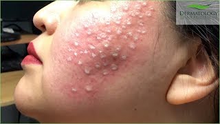 Acne Scar Treatment TCA Cross using TCA 80 [upl. by Leiva391]